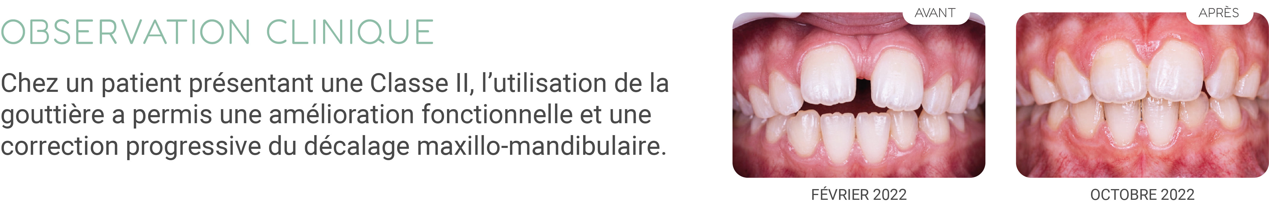 Classe II