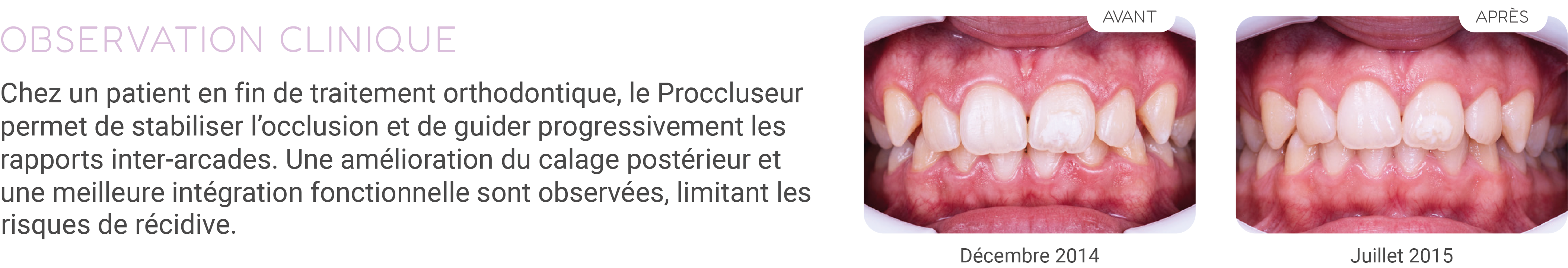 Proccluseur